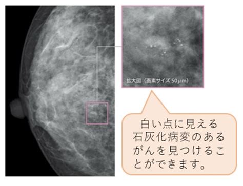 微細石灰化の集簇|乳がん検診のマンモグラフィ検査で石灰化があった場合について。